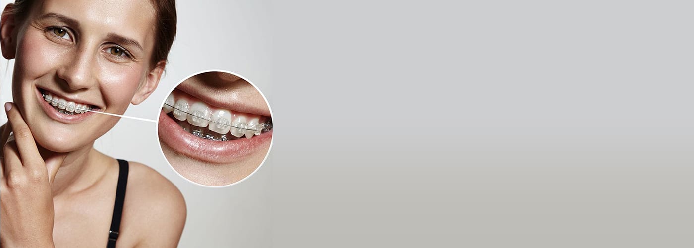 Fixed Braces Trowbridge Clear Fixed Braces Affordable Braces