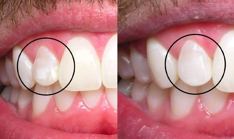 Teeth Whitening