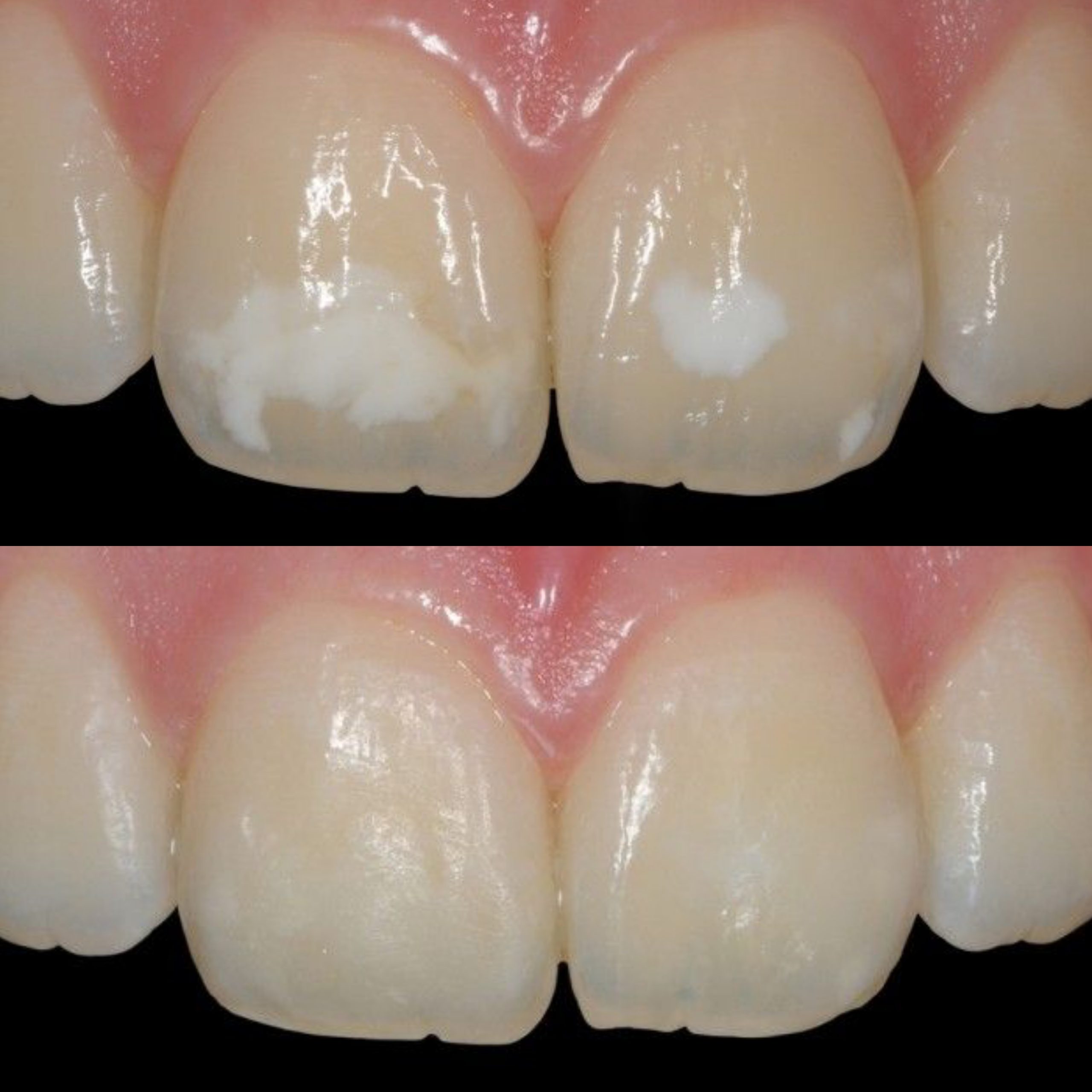Icon White Spot Removal